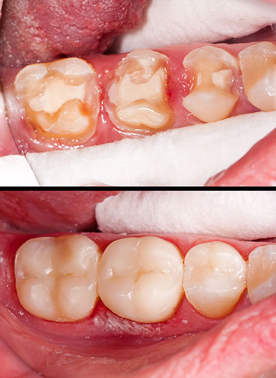 Full Mouth Reconstruction in Murrieta